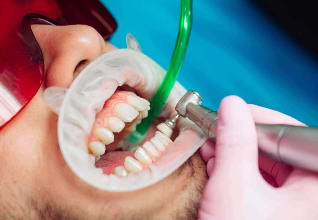 Удаление зубного камня — основные причины и противопоказания