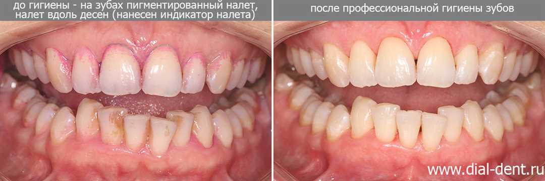 Удаление зубного камня с помощью терминального оборудования — эффективный и безболезненный метод профилактики и лечения стоматологических проблем