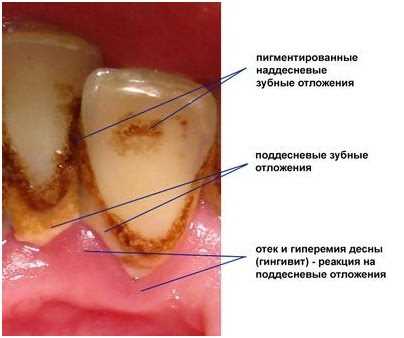Какие симптомы наблюдаются при наличии зубного камня