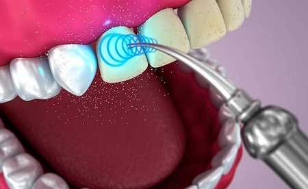 Способы снятия зубного камня