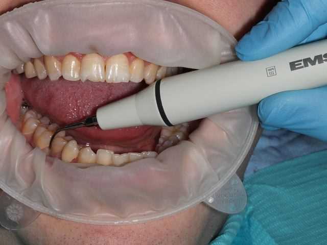 Преимущества и эффективность ультразвукового удаления зубного камня при профессиональной гигиене полости рта