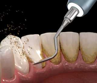 Удаление зубного камня врач