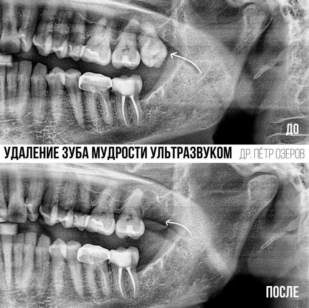 Этапы удаления зубов мудрости в ЦПС «Доктор Левин»