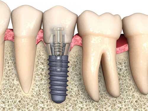 Показания к операции по сохранению зубов