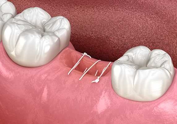 Наложение швов после удаления зуба советы стоматолога
