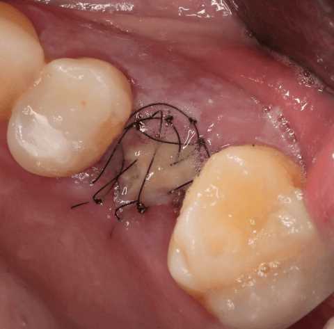 Почему болят швы после удаления зуба