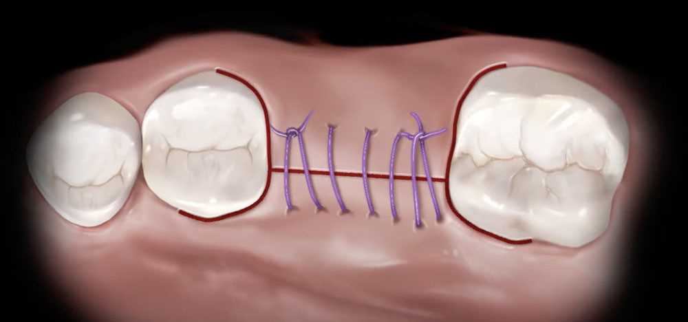 Как происходит удаление зубов шов без боли и последствий для здоровья