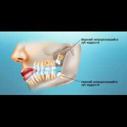 Показания и особенности удаления «мудрых зубов»