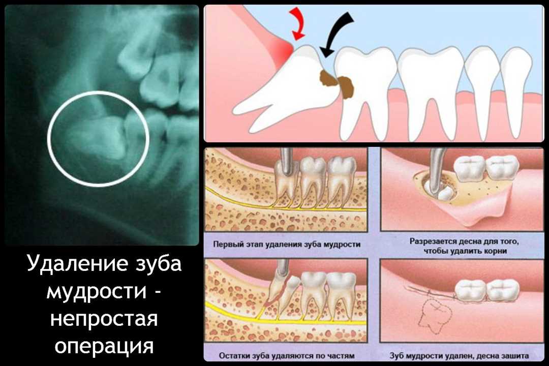 Как происходит удаление зубов в стационарных условиях и что следует знать перед процедурой