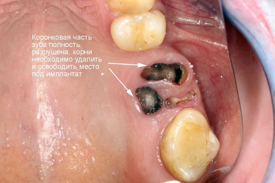 Зачем готовиться к ортодонтии и протезированию?