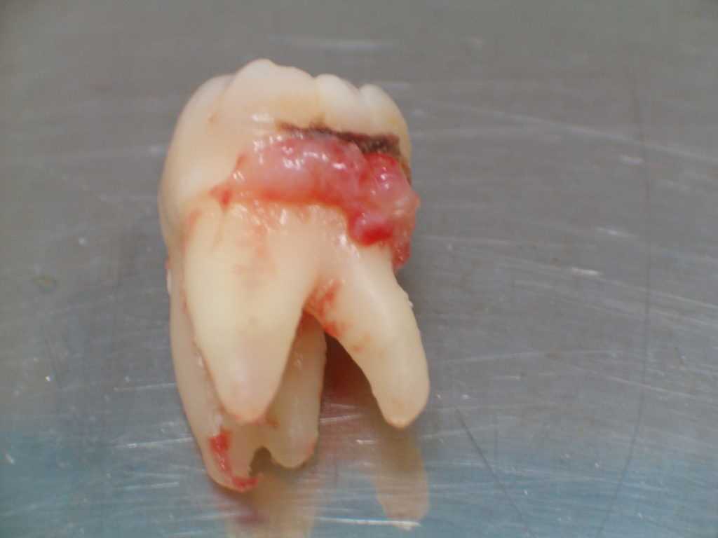 Инновационный метод удаления зубных коронок безболезненно и быстро — преимущества, результаты и сроки восстановления