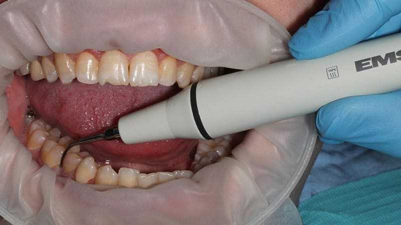 Преимущества ультразвукового удаления зубного камня в стоматологии Андерсон