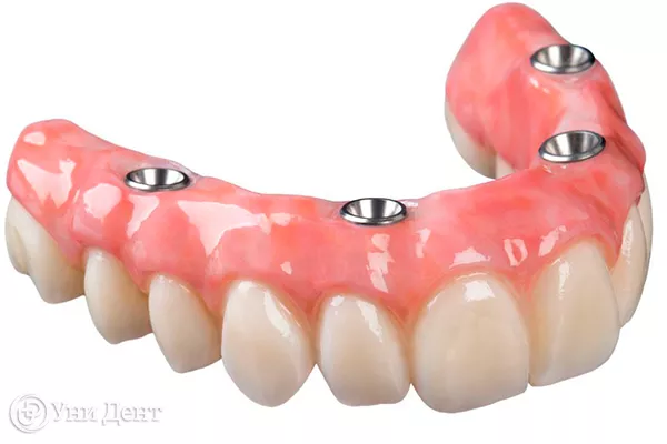 Преимущества условно-съемных зубных протезов на имплантах