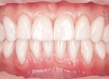 Показания и противопоказания к установке металлокерамических коронок на зубы
