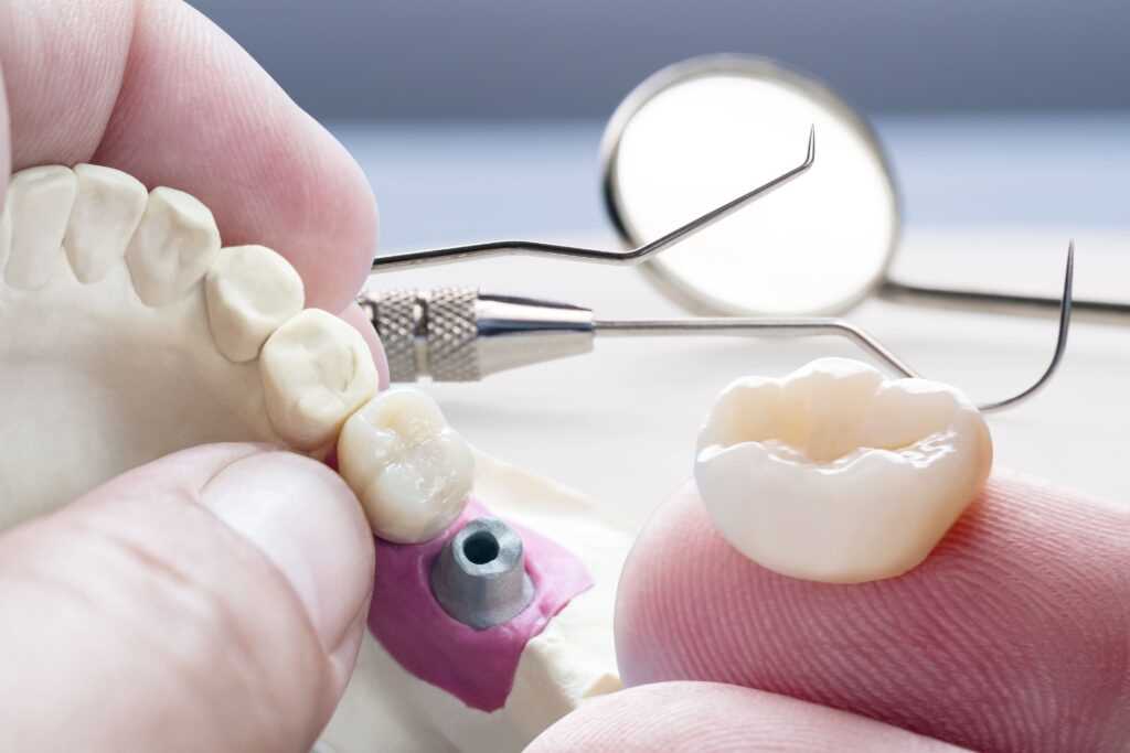 В 1.5 керамической зубной коронки содержится революционная технология нового поколения, обеспечивающая непревзойденную прочность и естественный цвет