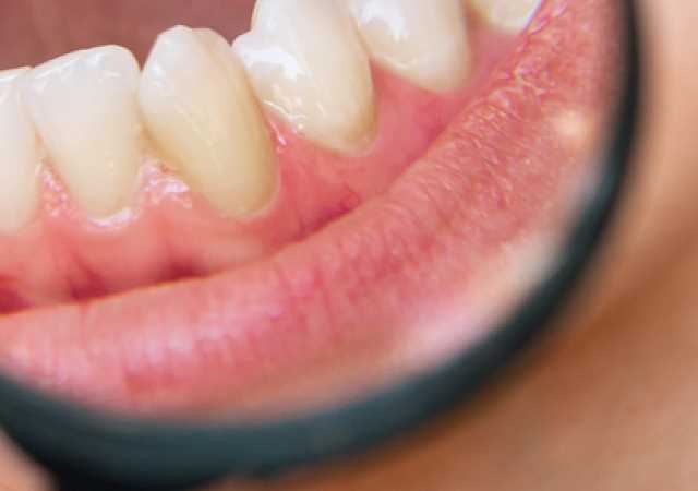 В ходе формирования зубного налета происходит