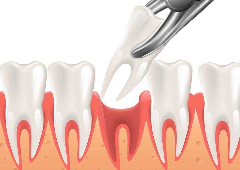 Какие проблемы могут возникнуть после удаления зубов?