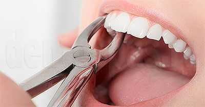 Как удаляют зубы?