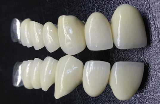 Какие разновидности зубных коронок ставят и какие из них предпочтительнее
