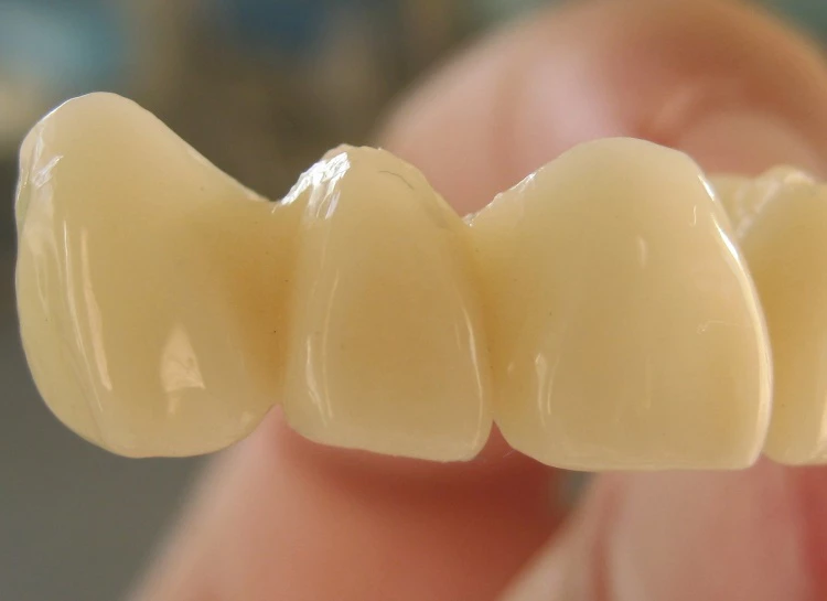 Какие коронки выбрать для передних зубов