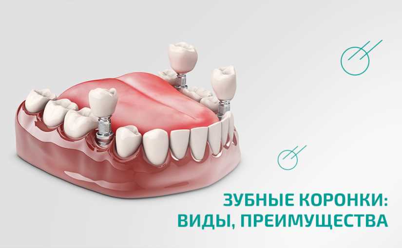 Виды зубных коронок, какие бывают, достоинства и недостатки