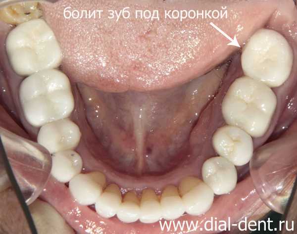 Воспаление зубного корня под коронкой лечение