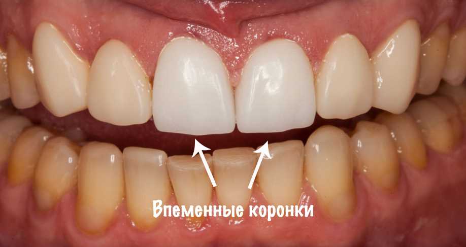 Временные зубные коронки — польза, необходимость и временные ограничения