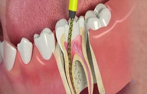 Важность лечения зубных каналов