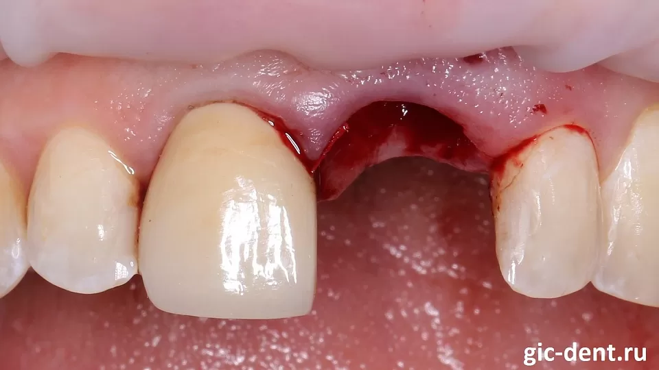 Временные протезы зубов — переходный этап на пути к здоровой улыбке