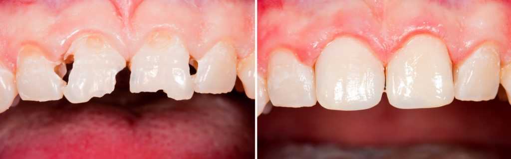 Временной реставрации зубов