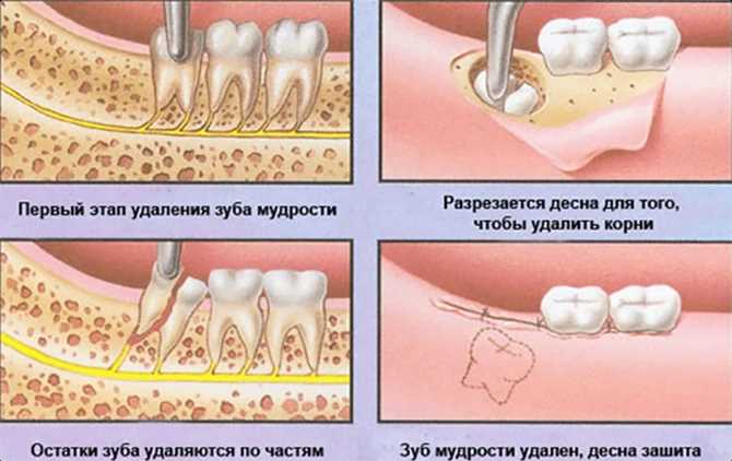 Удаление временных зубов