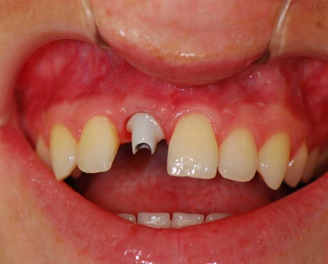 Показания к удалению временных зубов у детей