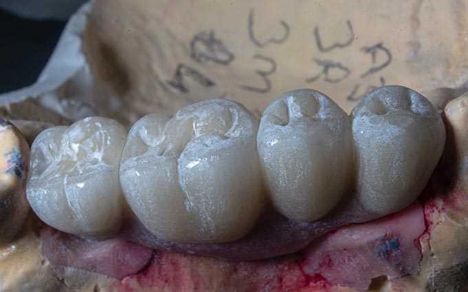Какие коронки лучше выбрать для жевательных зубов?
