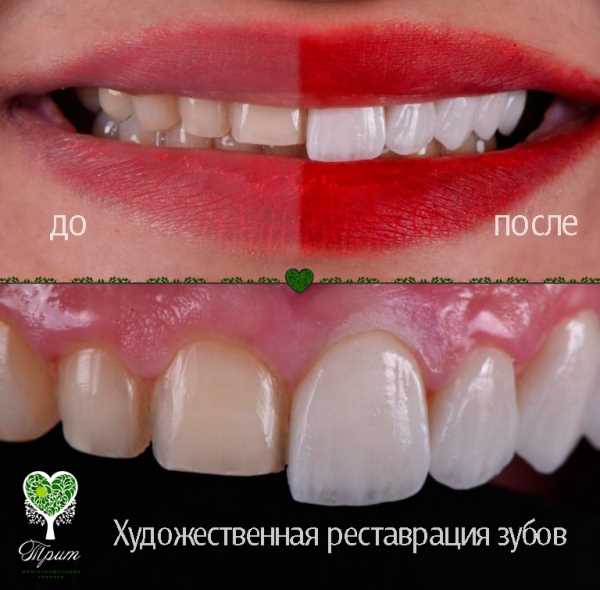 Цены на реставрацию зубов в Санкт-Петербурге