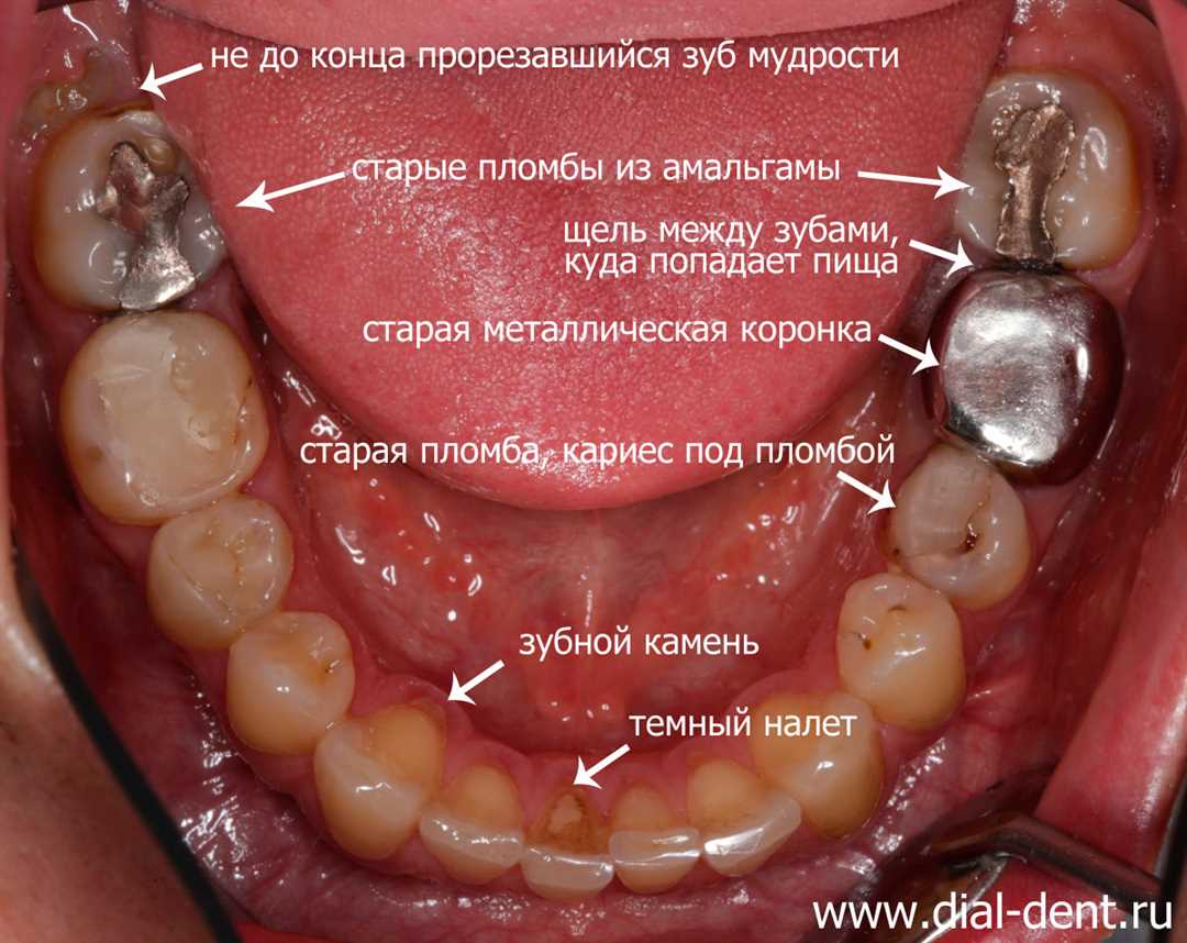 Показания и противопоказания к замене зубных коронок