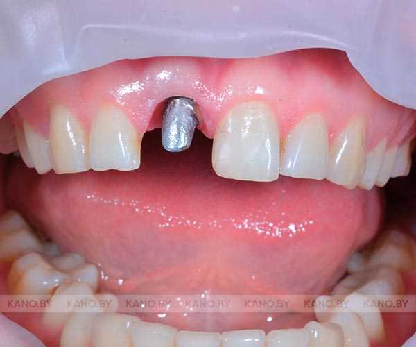 Противопоказания к замене зубной коронки