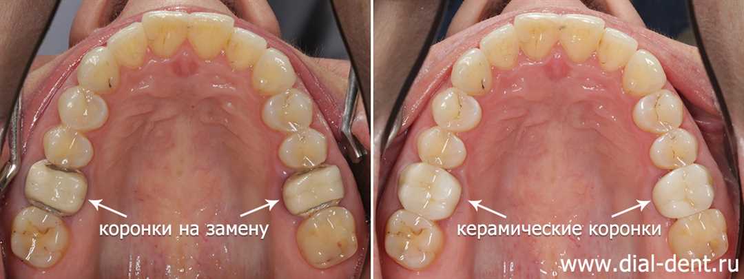 Все, что нужно знать о замене зубных коронок — симптомы, причины и процесс реставрации