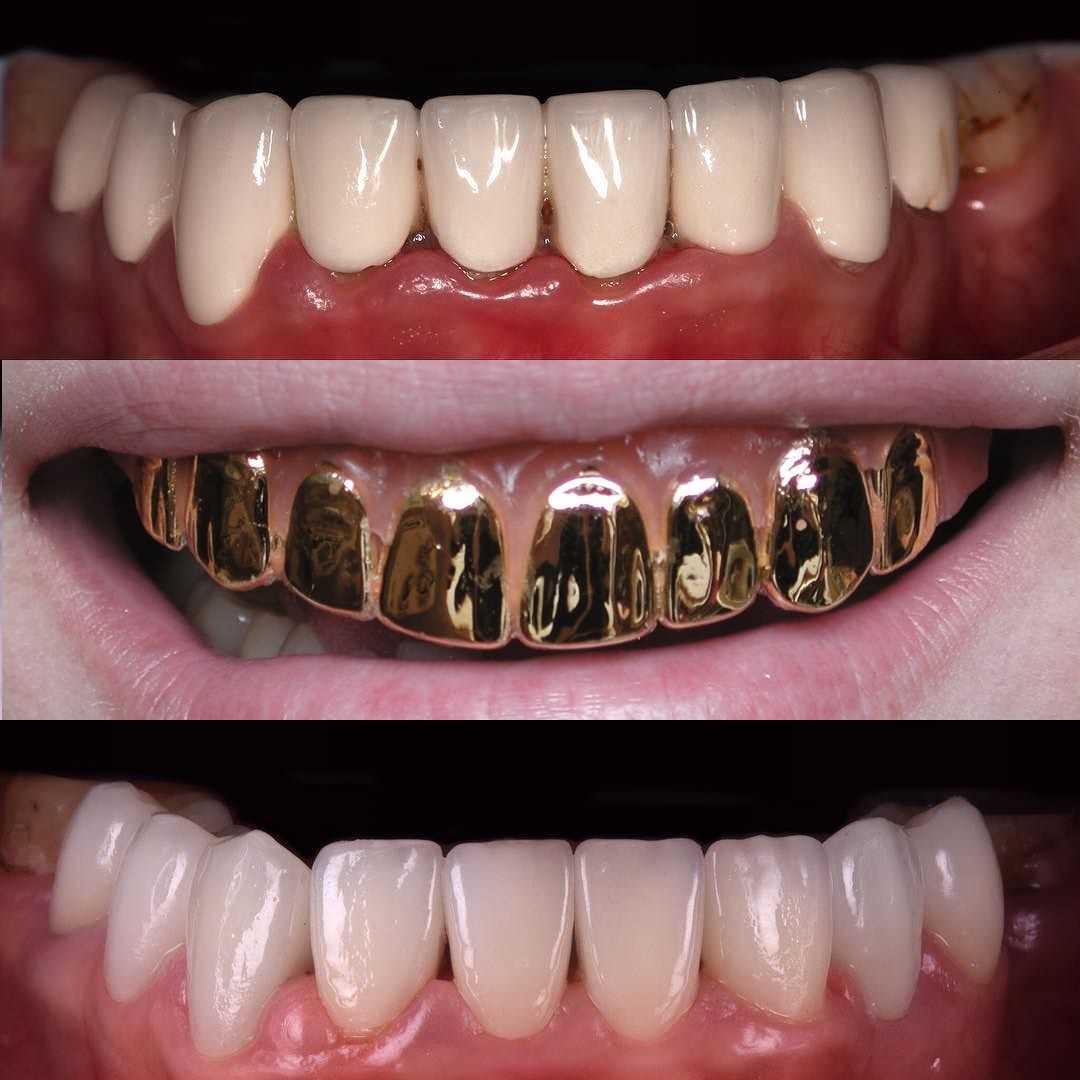 Желтение жизненного цвета зубных коронок может происходить из-за разных факторов. Возможные причины могут включать неправильную уход за коронками, употребление пищи и напитков, оказывающих повышенное пигментирующее воздействие на эмаль зубов, а также общий процесс старения и износа материала. Однако существуют различные методы, которые позволяют устранить или уменьшить желтение зубных коронок и восстановить их естественный белый цвет.