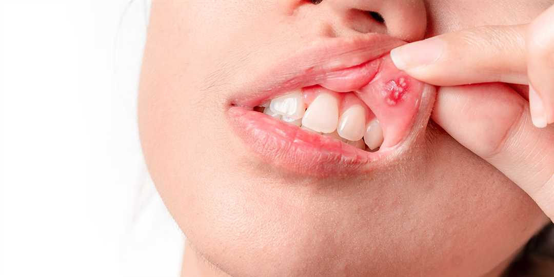 Синдром жжения полости рта