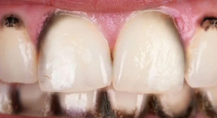 Роль зубного налета в формировании кариеса