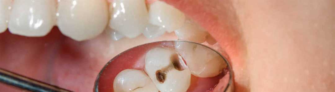 Почему после лечения зуб может стать чувствительным?