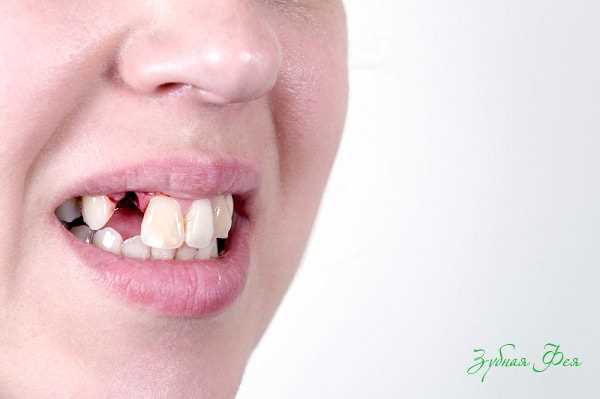 Когда и почему нужно удалять зубы курильщику — основные причины и последствия