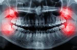 Осложнения после удаления зуба мудрости на нижней челюсти