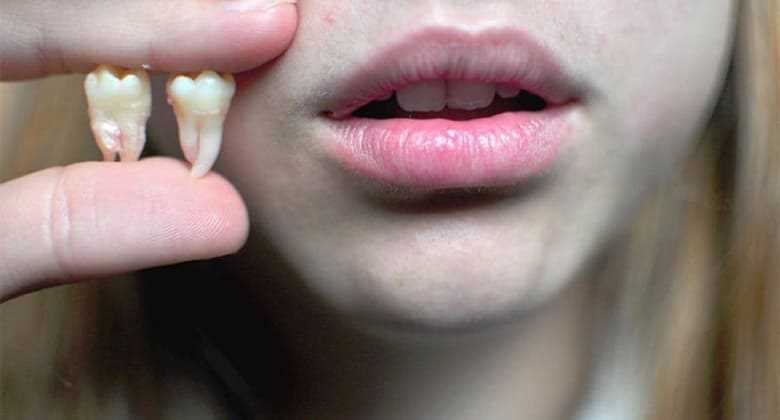 5 возможных осложнений после удаления зуба мудрости