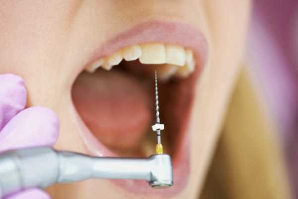 Удаляют ли нервы при протезировании зубов?