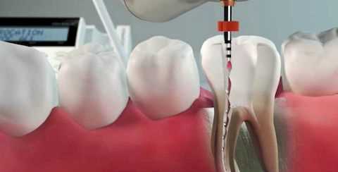 Зуб нерв протезирование удалять