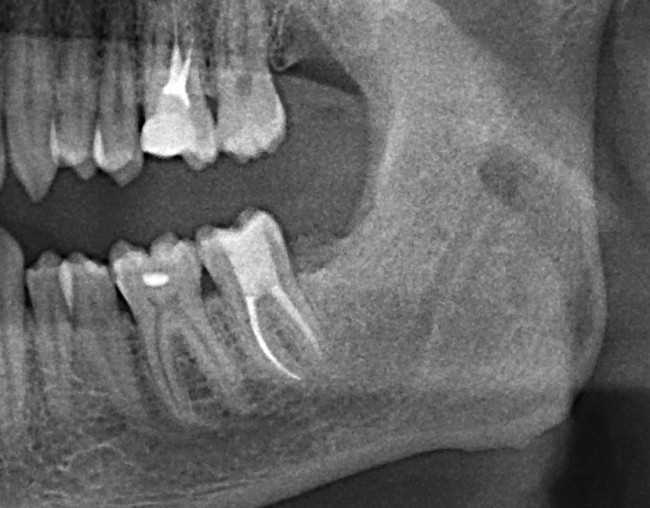 Лечение после удаления зуба