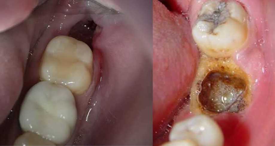 Зуб остеомиелит удаление