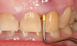 Когда понадобится удаление экзостоза зуба и как происходит процедура