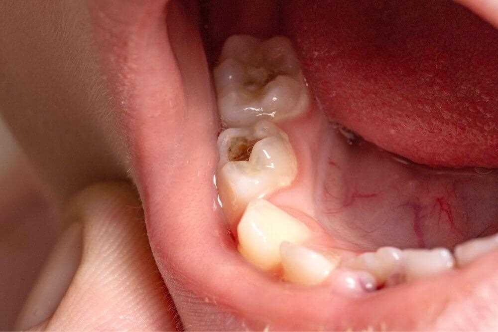 Зубы без анестезии ребенку